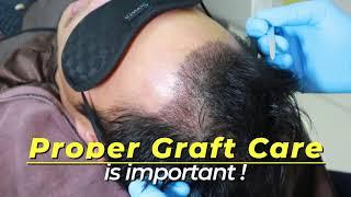 Hairline Transplant After 1 Week: A Remarkable Transformation | Glojas Aesthetic Clinic