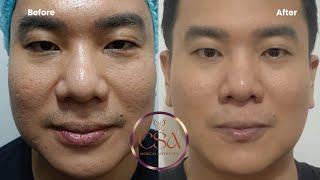 Acne scar management with Eladerm and skin booster