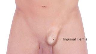 Inguinal Hernia