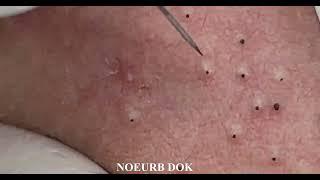 Popping Tons Of Blackheads Part 01