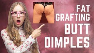 Butt Dimple Correction with Fat Grafting