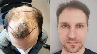 Hair Transplant Before and After - Month by Month results Elithair