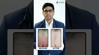  Psoriasis Treatment Results after 3 months #shorts #psoriasis  | Kayakap Global