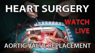 Heart Surgery (Aortic Valve Replacement) | Wach the Surgery from the Surgeon's View in 4K Ultra HD