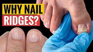 Why Nail Ridges? 6 Reasons You Should Know