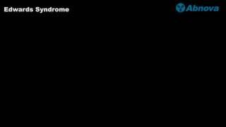 Edwards Syndrome