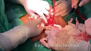 Total Penectomy - Wide local Excision - bilateral inguinal lymph node dissection
