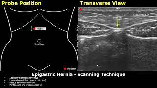 Epigastric Hernia Ultrasound Probe Positioning & Scanning Technique | Abdominal Wall USG Orientation