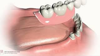 Teleskopprothese Köln - Erklärvideo - Ablauf