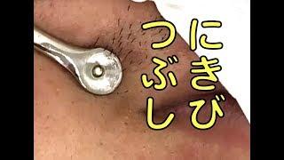 ニキビ潰し にゅるっと4連発【閲覧注意】acne treatment in Japan