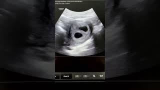 6 ҳафталик эгиз ҳомила #doctorYakubjonov #андролог #baby #уролог #бепуштлик #pregnant #гинеколог
