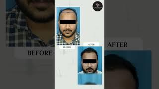 Inspiring Journey of hair transplantation | Dr. Rashmi Aderao Skin, Hair & Laser Clinic, Pune