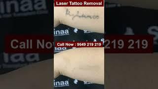 Everyone Loves Laser Tattoo Removal #shorts #lasertattooremoval #skinaaclinic