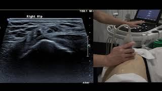Sonoanatomy Lateral Hip tendons - Ultrasound probe positioning