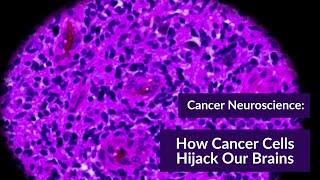 Cancer Neuroscience: how cancer cells hijack our brains