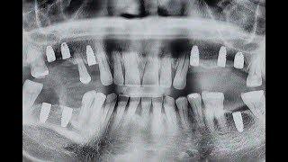 ICX-MAGELLAN: Schablonengeführte Implantation im Ober- und Unterkiefer mit ICX-Magellan System.