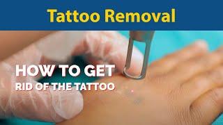 Tattoo Removal - How to get rid of the Tattoo | Tattoo Removal Laser Treatment | Dr. Jyoti Gupta MD