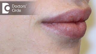 Causes of white spots on lips?-Dr. Nischal K