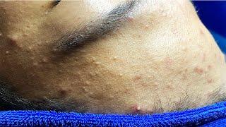 Hormonal changes are often responsible for acne | Mụn Do Thay Đổi Nội Tiết Tố - SacDepSpa#146