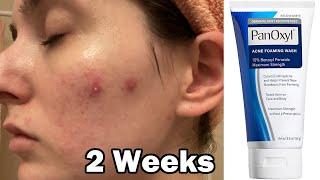 I tried panoxyl face wash for 2 weeks to clear my acne