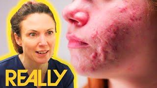 "I Can't Escape It!" Woman Feels Like Less Of A Person Due To Severe Acne | The Bad Skin Clinic