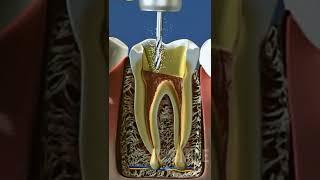 Root canal #shorts