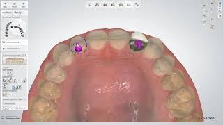 3Shape 덴탈시스템 – 임시치아 디자인 – 3Shape Dental System – Temporary Design