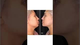 Non-Surgical Jawline Contouring