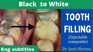 Black colour filling replaced by tooth colour one | silver amalgam to injectable composite |