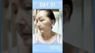 [SHORTS] Incisional Face Lifting, Blepharoplasty, Face Liposuction, Face Fat Grafting All in Korea!