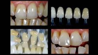 dental optical guide 02