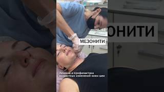Армирование кожи шеи нитями из полимолочной кислоты