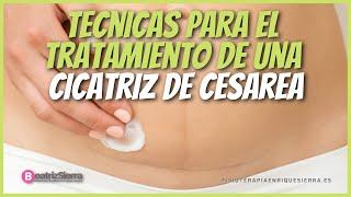 Cicatriz de cesarea tecnicas de tratamiento despues del parto fisioterapia