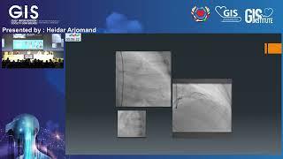 20  Heidar Arjomand   Cardiogenic Shock, Where Impella Worked, Show me the Data Pro