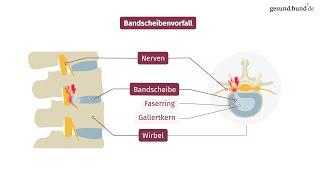 Was ist ein Bandscheibenvorfall?