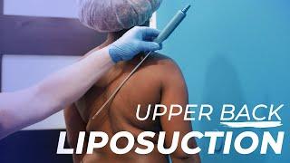 Upper Back Liposuction