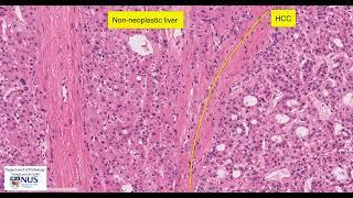 Liver: Hepatocellular carcinoma Microscopy - Talking slide