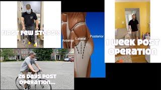 Total Hip Replacement   Anterior Approach   0 to 4 week Recovery