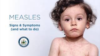 Measles Signs and Symptoms