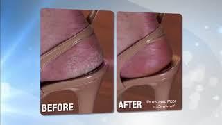 As Seen On TV -Personal Pedi-Remove hard, ugly callouses with Personal Pedi As seen on tv