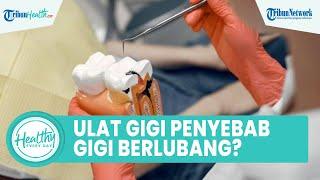 Mitos atau Fakta Ulat Gigi Penyebab Gigi Berlubang? Ini Penjelasan Dokter Gigi