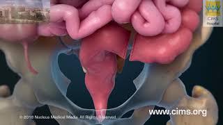 Rectum Removal (Hindi) – CIMS Hospital