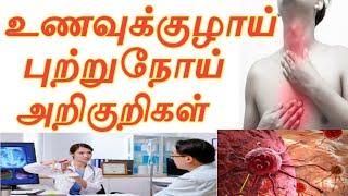 Unavu kulai Cancer symptoms in Tamil/Cancer symptoms in Tamil/Cancer avoid food's in Tamil/Cancer