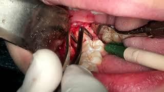 lower third molar in contact to mandibular nerve