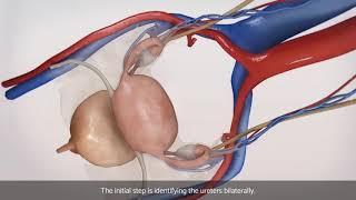 Laparoscopic bilateral salpingo-oophorectomy (BSO)