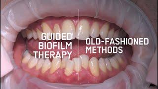 Guided Biofilm Therapy VS Old Hygiene Treatment