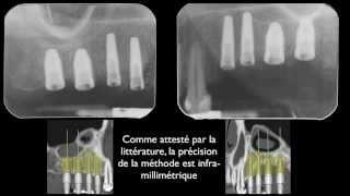 Implantologie assistée par ordinateur/Computer guided implantology