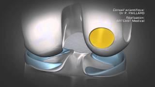 Les lésions cartilagineuses du genou