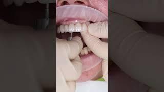 Dental implant’s All on 4 in Prague #shorts #dentist #dental #implant #veneers #short