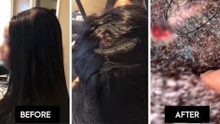 NATURAL HAIR HORROR STORY! I can't even BELIEVE this! I GOT A SCALP INFECTION